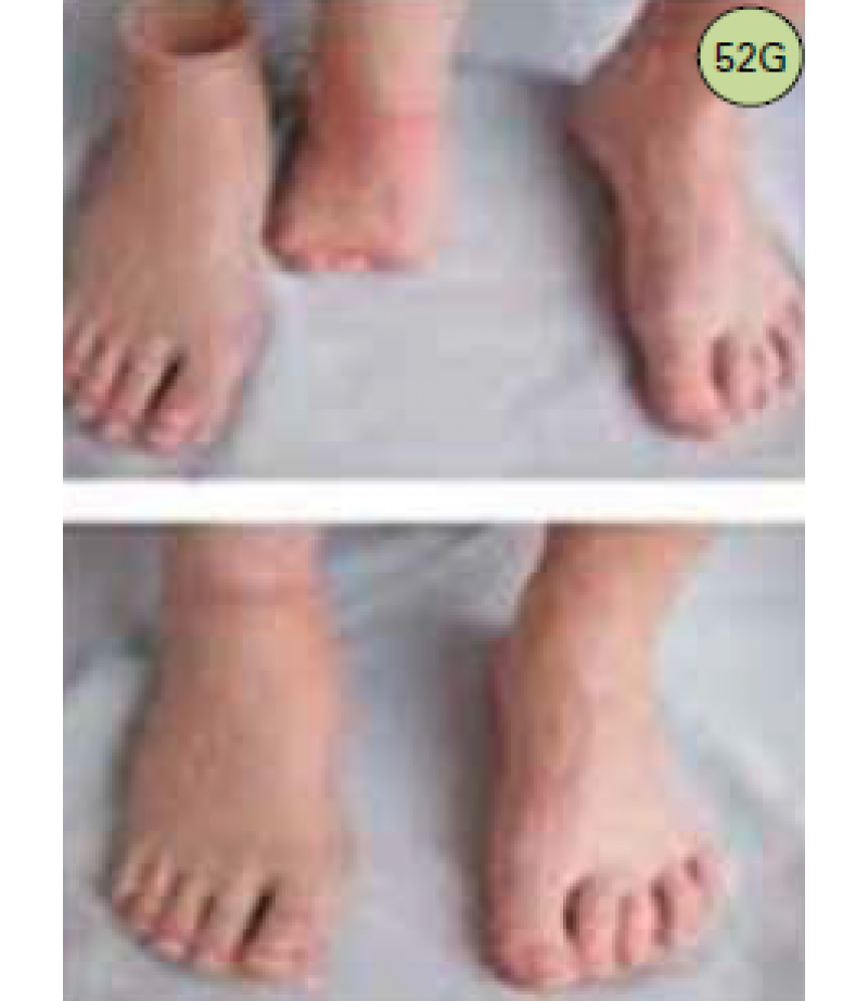 SILICONE FOOT (COSMETIC FOOT) 